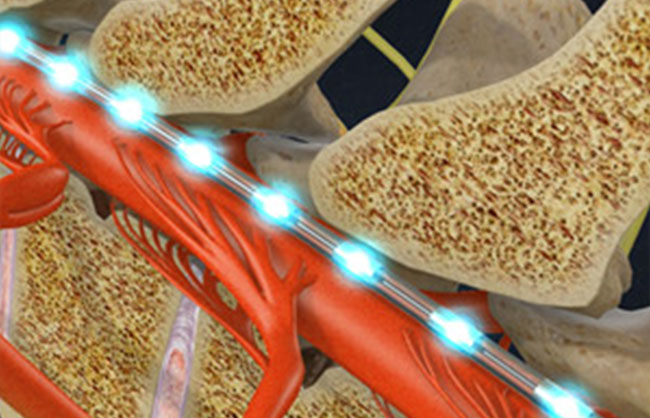 Spinal Cord Stimulators treatment at ReMeDy Medical Group